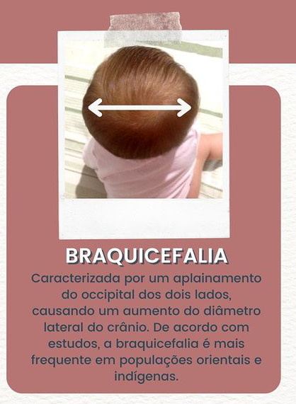 Braquicefalia - Osteopatia Pediátrica